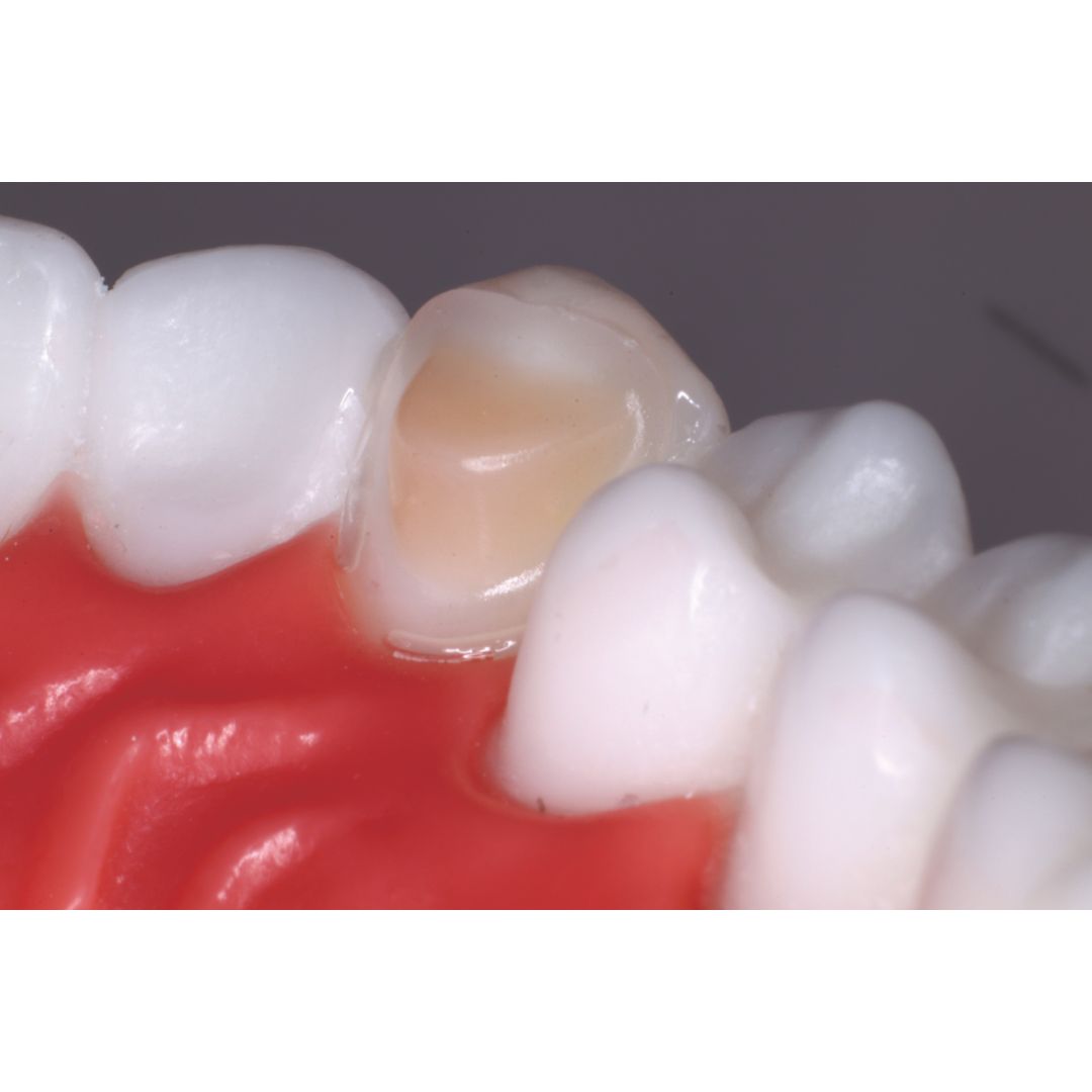 Reliamold Cuspid Attachment