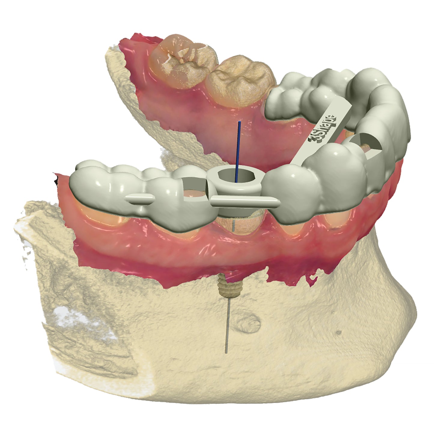 3Shape Implant Planner